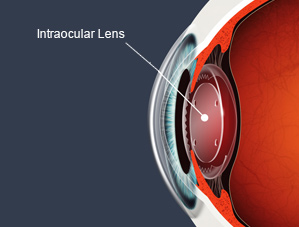 Intraocular Lens and no stitch cataract surgery Downey and Cerritos Ca.