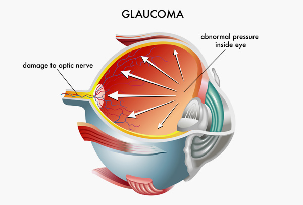 What is Glaucoma